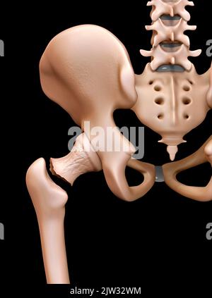 Illustration montrant une vue arrière d'une fracture dans le cou du fémur (os de la cuisse). Banque D'Images