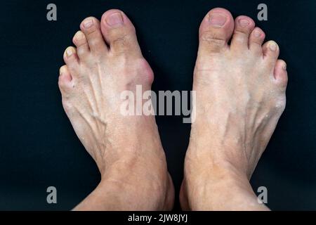 Un pied avec un bunion goutte comparé à un pied normal isolé sur fond noir. Banque D'Images