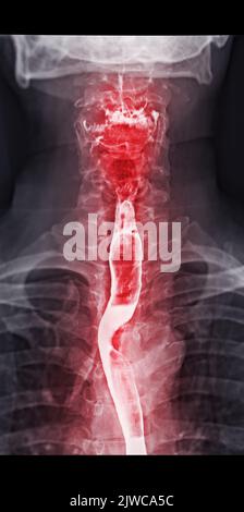 Examen de l'étude de baryum Swallow diagnostic de Barrett examen du tractus gastro-intestinal GERD série ulcères difficulté procédure pharynx UGI gorge traitement de l'intestin par fluoroscopie dev Banque D'Images