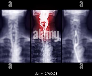 Examen de l'étude de baryum Swallow diagnostic de Barrett examen du tractus gastro-intestinal GERD série ulcères difficulté procédure pharynx UGI gorge traitement de l'intestin par fluoroscopie dev Banque D'Images