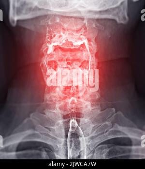 Examen de l'étude de baryum Swallow diagnostic de Barrett examen du tractus gastro-intestinal GERD série ulcères difficulté procédure pharynx UGI gorge traitement de l'intestin par fluoroscopie dev Banque D'Images