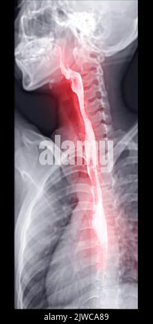 Examen de l'étude de baryum Swallow diagnostic de Barrett examen du tractus gastro-intestinal GERD série ulcères difficulté procédure pharynx UGI gorge traitement de l'intestin par fluoroscopie dev Banque D'Images