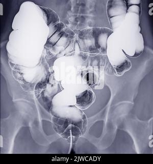 L'enema de baryum ou L'ÊTRE est l'image d'un gros intestin après l'injection d'un remplissage de contraste de baryum dans le côlon sous contrôle fluoroscopique isolé sur fond blanc Banque D'Images