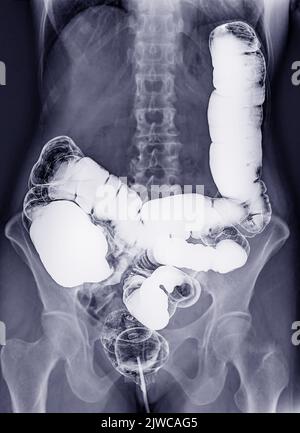 L'enema de baryum ou L'ÊTRE est l'image d'un gros intestin après l'injection d'un remplissage de contraste de baryum dans le côlon sous contrôle fluoroscopique isolé sur fond blanc Banque D'Images