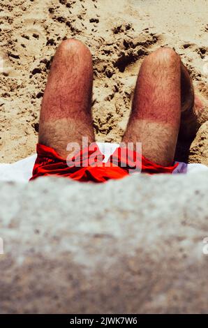 Gros plan sur les jambes brûlées au soleil d'un homme non identifiable sur la plage avec des coups de feu rouges Banque D'Images