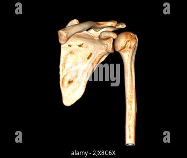 Tomodensitométrie rendu de volume examen du rendu de l'épaule 3D dans l'articulation de l'épaule du patient. Banque D'Images