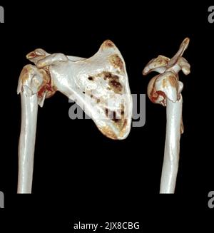 Tomodensitométrie rendu de volume examen du rendu de l'épaule 3D dans l'articulation de l'épaule du patient. Banque D'Images