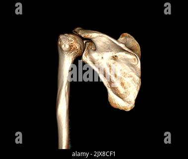Tomodensitométrie rendu de volume examen du rendu de l'épaule 3D dans l'articulation de l'épaule du patient. Banque D'Images