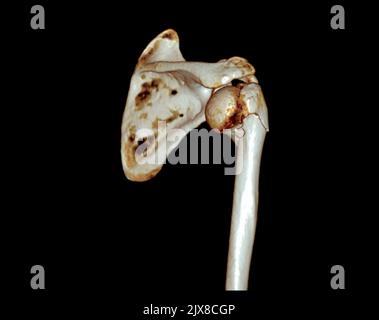 Tomodensitométrie rendu de volume examen du rendu de l'épaule 3D dans l'articulation de l'épaule du patient. Banque D'Images