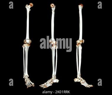 Acquisition CT de l'extrémité inférieure 3D pour le diagnostic de fracture de l'os du fémur , de l'articulation du genou , de la jambe et du pied 3D rendu Banque D'Images