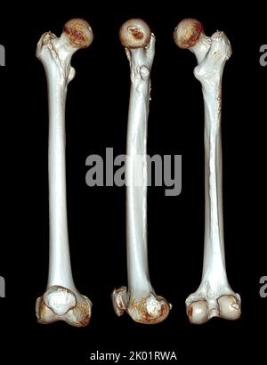 Acquisition CT de l'os du fémur et de l'os de la cuisse 3D pour le diagnostic de fracture de l'os du fémur isolé sur fond noir. Masque. Banque D'Images