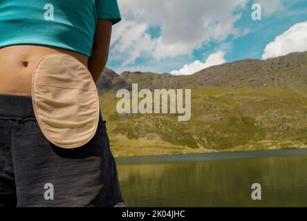 Femme avec sac de colostomie dans les montagnes. Banque D'Images