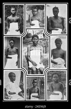 Le roi Léopold II, de l'administration belge de l'État libre du Congo, a été caractérisé par des atrocités, dont la torture et les meurtres, résultant d'une brutalité systématique notoire. Les mains d'hommes, de femmes et d'enfants ont été amputées lorsque le quota de caoutchouc n'a pas été atteint et que des millions de Congolais sont morts. Banque D'Images