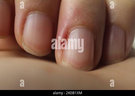 plaque à ongles endommagée avec inflammation de la plaie en gros plan. Soins des mains maladies des ongles maladies des ongles. Banque D'Images