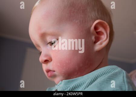 Allergie aux éruptions cutanées sur le visage d'un tout-petit. Banque D'Images