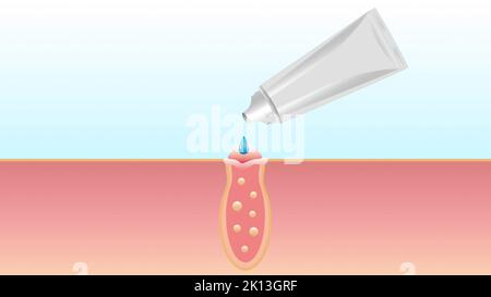 Le processus d'élimination de l'acné, le nettoyage des pores, le traitement de la peau, l'exposition au gel, pommade, produit médical. Banque D'Images