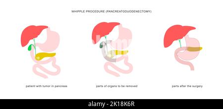 Infographie médicale de la procédure de whipple pancréaticoduodénectomie. Opération chirurgicale dans le traitement du cancer du pancréas. Illustration de Vecteur