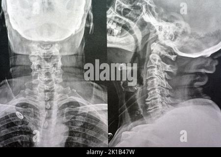 Vertèbres cervicales à rayons X simples montrant le redressement des vertèbres cervicales indiquant un spasme musculaire et une spondylosis légère à modérée à partir de C3 3rd cervicales Banque D'Images