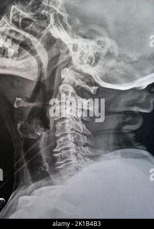 Vertèbres cervicales à rayons X simples montrant le redressement des vertèbres cervicales indiquant un spasme musculaire et une spondylosis légère à modérée à partir de C3 3rd cervicales Banque D'Images