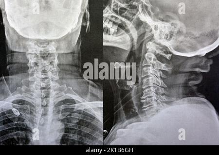 Vertèbres cervicales à rayons X simples montrant le redressement des vertèbres cervicales indiquant un spasme musculaire et une spondylosis légère à modérée à partir de C3 3rd cervicales Banque D'Images