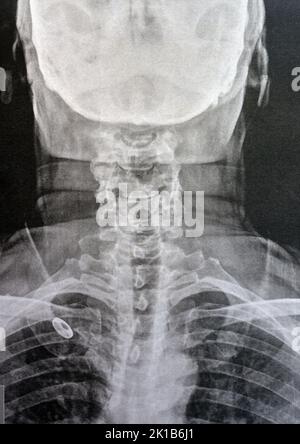 Vertèbres cervicales à rayons X simples montrant le redressement des vertèbres cervicales indiquant un spasme musculaire et une spondylosis légère à modérée à partir de C3 3rd cervicales Banque D'Images