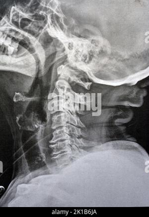 Vertèbres cervicales à rayons X simples montrant le redressement des vertèbres cervicales indiquant un spasme musculaire et une spondylosis légère à modérée à partir de C3 3rd cervicales Banque D'Images