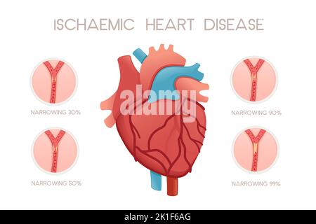 Coeur humain malsain avec la maladie ischémique illustration de l'anatomie problème de santé illustration du vecteur sur fond blanc Illustration de Vecteur