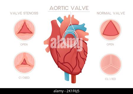 Coeur humain sain avec valves et sténose valvulaire maladie illustration anatomie problème santé illustration vecteur sur fond blanc Illustration de Vecteur