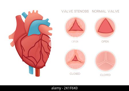 Coeur humain sain avec valves et sténose valvulaire maladie illustration anatomie problème santé illustration vecteur sur fond blanc Illustration de Vecteur