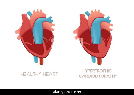 Coeur et coeur humains sains avec cardiomyopathie hypertrophique illustration anatomie problème de santé illustration vecteur sur fond blanc Illustration de Vecteur