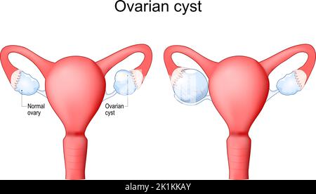 Kyste ovarien Utérus humain avec sac rempli de liquide à l'intérieur de l'ovaire. Système reproducteur féminin. Illustration vectorielle Illustration de Vecteur