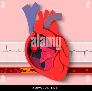 Crise cardiaque papier coupé vecteur maladie de cardiologie Illustration de Vecteur