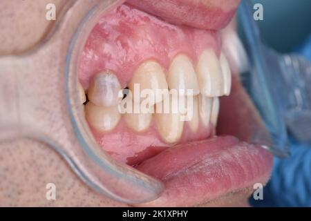 Gros plan dents dentiste problème dentaire examen avant traitement douleur dentaire Banque D'Images