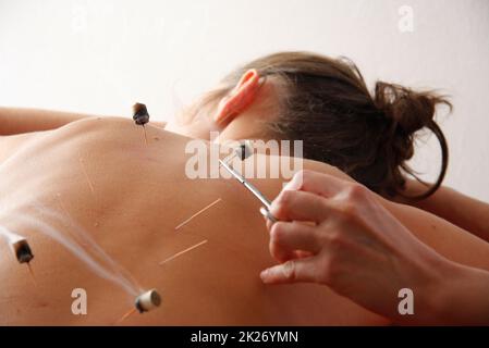 la femme se détend de la procédure d'acupuncture. Une acupuncture acupuncturiste doong très précisément. Médecine chinoise traditionnelle Banque D'Images