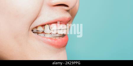 Gros plan dents blanches de jeunes asiatique belle femme souriante porter des pièces de retenue en silicone orthodontique Banque D'Images