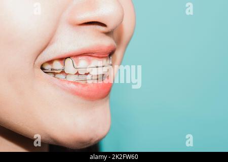 Gros plan dents blanches de jeunes asiatique belle femme souriante porter des pièces de retenue en silicone orthodontique Banque D'Images