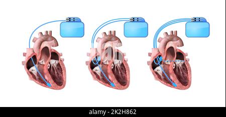 cœur et stimulateur cardiaque sur fond blanc 3d rendu, anatomie cardiaque, section, ventricule droit et gauche, oreillettes, valves Banque D'Images