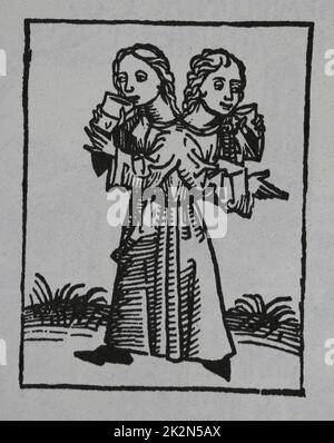 Jumeaux joints ou siameses jumeaux. Gravure. Le Cronicle de Nuremberg, 15th siècle. Banque D'Images