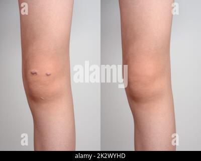 Genou d'une fille avec cicatrice keloïde, avant et après le traitement Banque D'Images