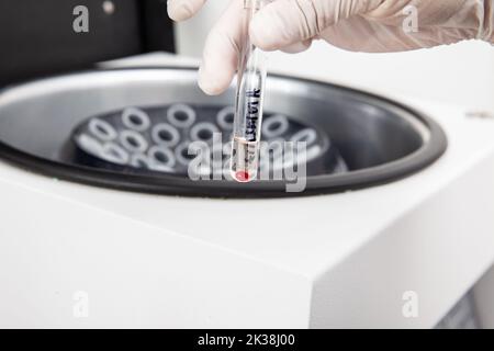 Tube à essai avec culot de cellules de moelle osseuse obtenu après centrifugation. Scientifique préparant des échantillons de moelle osseuse pour l'analyse cytométrique de flux en laboratoire Banque D'Images