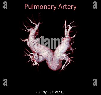 CTA artères pulmonaires 3D rendu montrant la branche de l'artère pulmonaire Banque D'Images