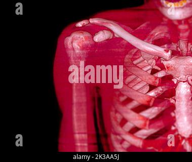 Tomodensitométrie rendu de volume examen du rendu de l'épaule 3D dans l'articulation de l'épaule du patient. Banque D'Images