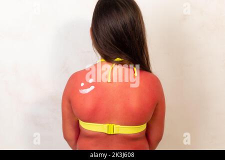 Arrière de la fille avec de graves brûlures rouges après avoir passé du temps au soleil, fond gris. Enfant en maillot de bain jaune appliquant après la crème solaire sur les zones enflammées de Banque D'Images