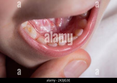 Un molaire permanent chez un enfant grandit à la deuxième rangée. Croissance incorrecte des molaires ou de la polyodontie en dentisterie. Banque D'Images