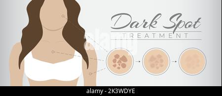 Dark Spot Treatment Illustration Design avec la pigmentation de la peau de la femme et du mélasma Illustration de Vecteur