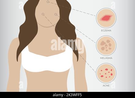 Illustration de l'eczéma, de l'acné et du mélasma avec la femme fond Illustration de Vecteur