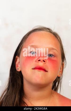 Portrait gros plan de petite fille avec de graves brûlures rouges sur le nez et les joues après avoir passé du temps au soleil, fond gris. Enfant avec zones enflammées de Banque D'Images