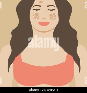 Fille ou femme avec melasma. Points de pigmentation Illustration Design Illustration de Vecteur