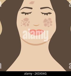 Femme avec melasma sur son visage. Illustration d'une personne présentant une pigmentation de la peau par des taches sombres Illustration de Vecteur