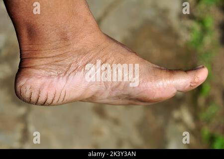 Talons secs et fissurés en raison du manque d'humidité dans les pieds Banque D'Images